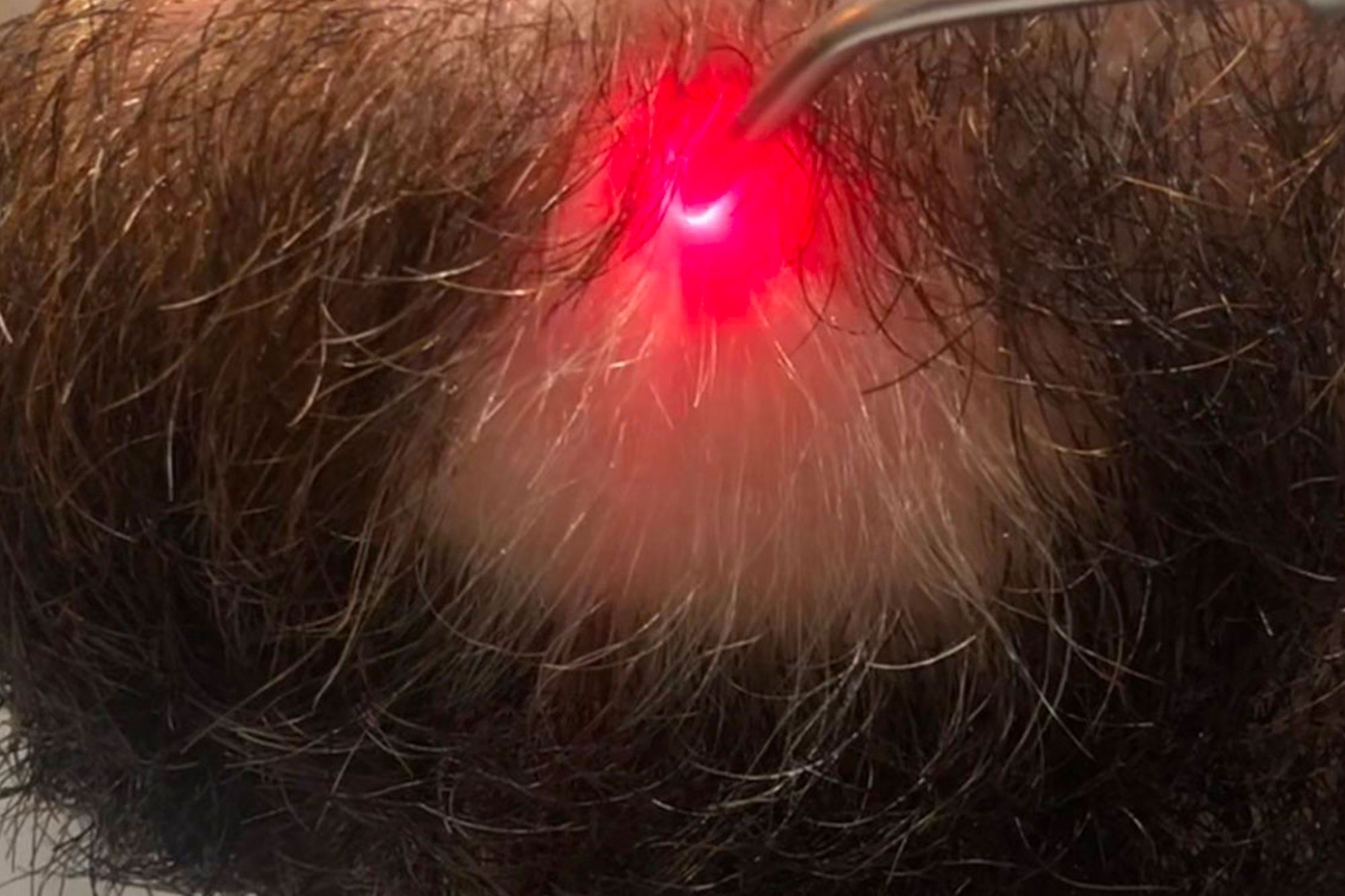 tratamientos-laserpen-barba.jpg